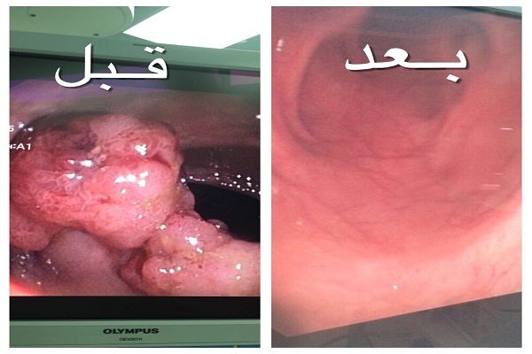 فريق طبي يزيل ورم كبير بدون تدخل جراحي بمستشفى الملك فهد بالمدينة