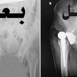 “صحة مكة” تطلق حملة التوعية بسرطان الثدي