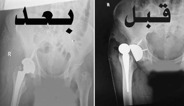 جراحة ناجحة بمستشفى بريدة المركزي لتركيب مفصل صناعي تنهي معاناة مريض