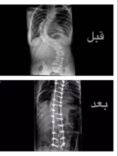 نجاح عملية تقويم عمود فقري لفتاة بـ”سعود الطبية”