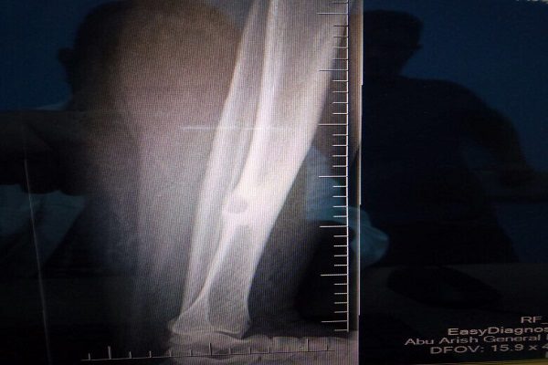 نجاح إزالة “خراج” عميق في عظام الساق الأيسر لمريضة بمستشفى أبور عريش العام