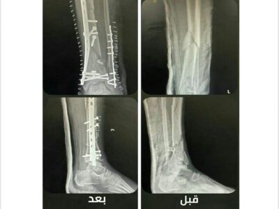 تدخل طبي ناجح في مجمع الملك عبدالله بجدة لإنقاذ مصاب من شلل نصفي