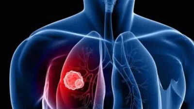 3 أسباب لـ«سرطان الرئة».. و5 علامات تكشف الإصابة بالمرض