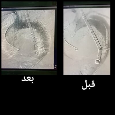 قسطرة جراحية تداخلية في مجمع الملك عبدالله الطبي بجدة لإنقاذ حياة مريض