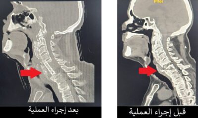 المستشفى السعودي الألماني بحائل يعيد الحركة لسبعيني بعد استبدال الفقرات العنقية