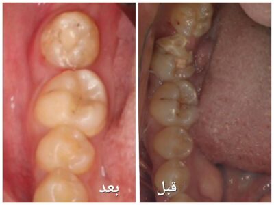 بإستخدام التقنية الحديثة.. فريق طبي لعلاج جذور الأسنان ينهي معاناة حالتان بجدة