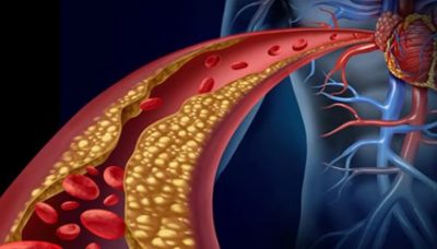 تحذير لأصحاب الكولسترول المرتفع.. “النمر”: إيقافك للدواء يقودك لهذا الوضع