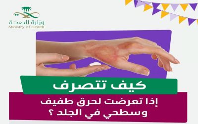 4 نصائح وتجنّب مثلها.. كيف تتصرف إذا تعرضتَ لحرق سطحي وطفيف؟